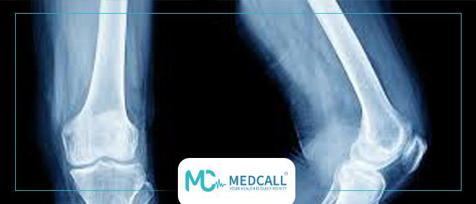 اشعة هشاشة العظام