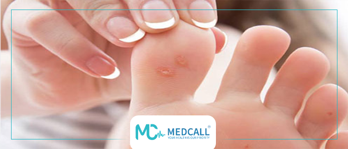 علاج الفقاعات الجلدية في مرض السكر