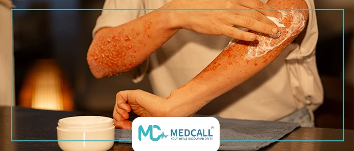 علاج فقاعات الحروق في المنزل