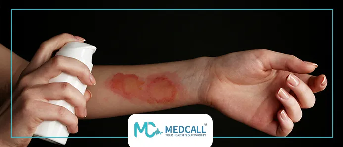 افضل علاج للحروق