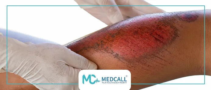 علاج الحروق البسيطة بالمنزل