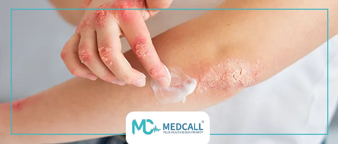 لعلاج الحروق في المنزل